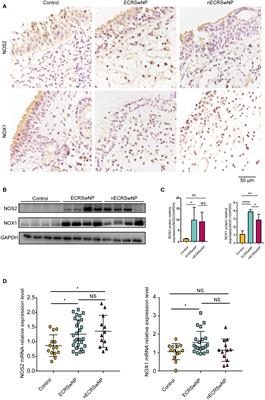 The oxidant-antioxidant imbalance was involved in the pathogenesis of chronic rhinosinusitis with nasal polyps